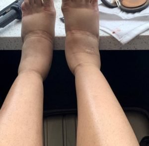 Cardi B swollen feet