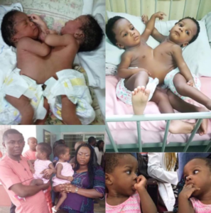 Conjoined Twins Successfully Operated in Abuja